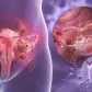 Endometriosis dan Kesuburan: Menghadapi Hambatan Pembuahan